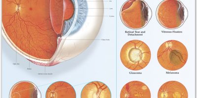 Disorders of the Eye {Infographic}