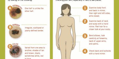 How to Spot Skin Cancer {Infographic}