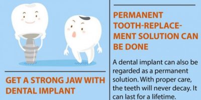 7 Must Know Facts About Dental Implants [Infographic]